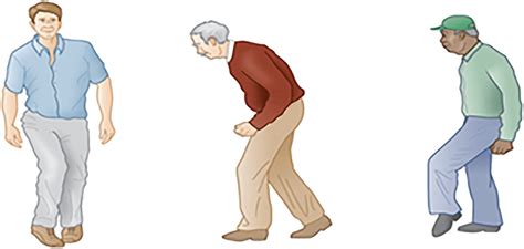 Hemiplegic gait, Parkinson gait, neuropathic gait | Download Scientific ...