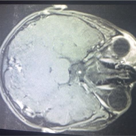 Magnetic resonance imaging (MRI) of the eye; a mass lesion of soft ...