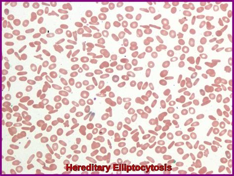 Elliptocytosis - Ask Hematologist | Understand Hematology