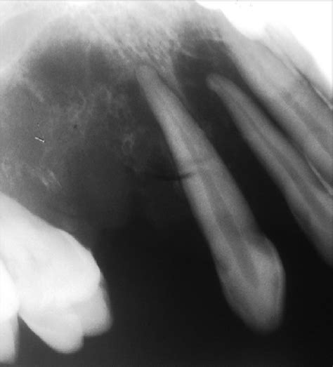 Periapical radiograph of the right maxillary canine region | Download ...