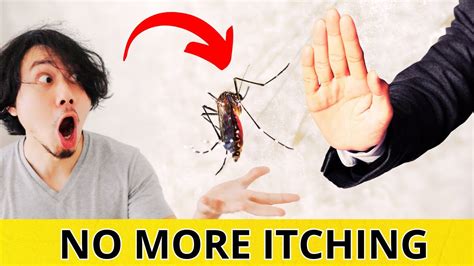 Quick Tips To Stop Mosquito Bites From Itching Instantly YouTube