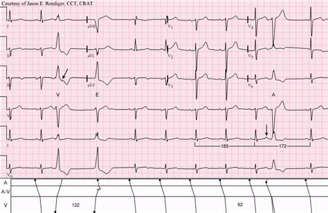 Ventricular escape beat | ECG Guru - Instructor Resources