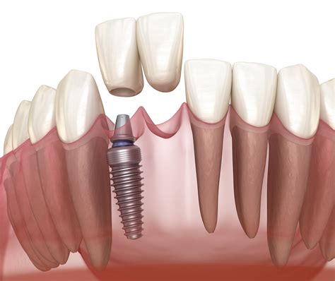 Cantilever Bridge Implant Based Frontal Tooth Recovery Medically