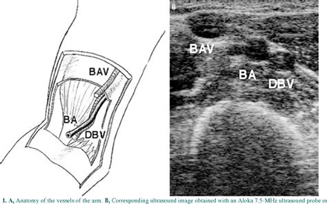 Brachial Vein Ultrasound