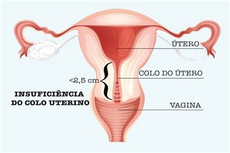 Cerclagem Uterina O Que E Como Feita A Cirurgia Para Segurar O