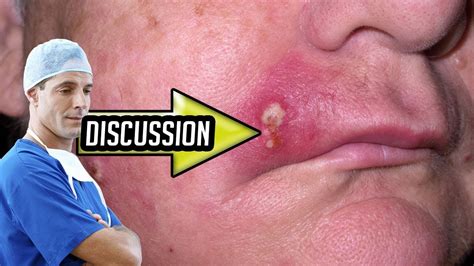 Staph Infections And Cellulitis What Is Staph Youtube