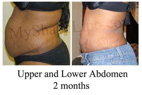 Full Body Liposuction Why Some Women Are Taking Body Contouring To