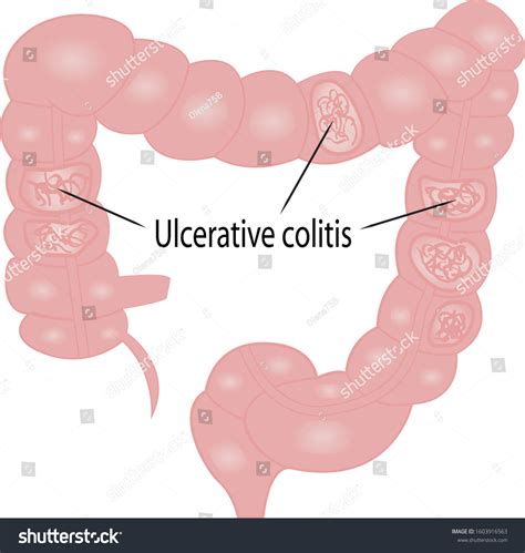 Ulcerative Colitis Intestine Disease Vector Royalty Free Stock Vector