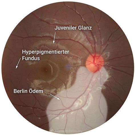 Berlinödem Netzhaut Fundus Trainer