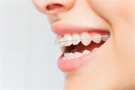 Clear Braces | West Hills Orthodontics