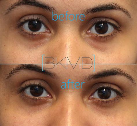 Under Eye Filler Dr Brett Kotlus