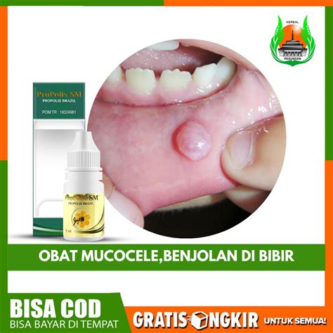 Jual Obat Mukokele Benjolan Isi Lendir Di Dalam Mulut Mucocele Benjolan Di Dalam Bibir Bawah