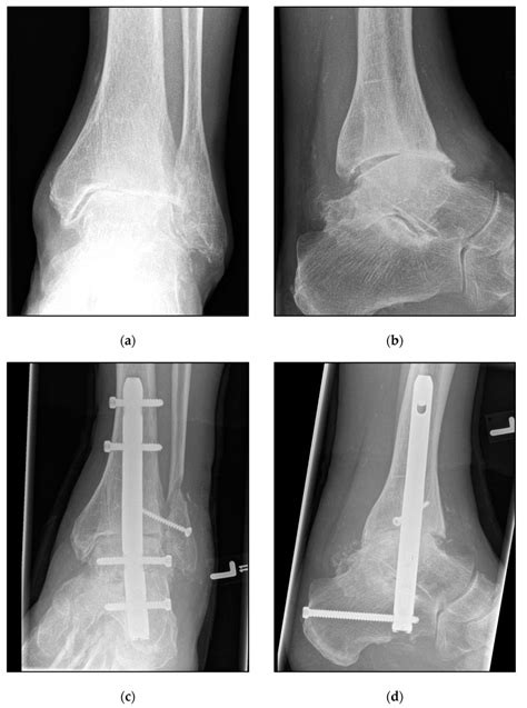 Pre And Postoperative Radiographic Findings Of End Stage Posttraumatic