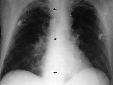 Percutaneous Retrieval Of A Lost Guidewire That Caused Cardiac