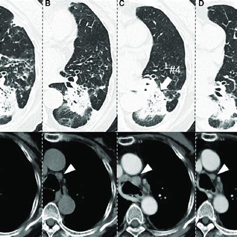 A And B At The Current Admission Chest Computed Tomography Ct Download Scientific Diagram