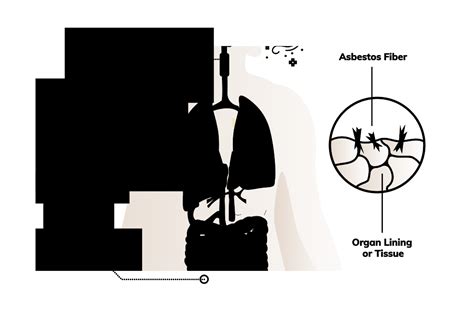 Asbestos Cancer | What Types Are Caused by Asbestos & How?