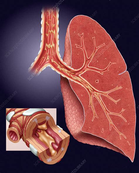 Bronchitis Stock Image M120 0153 Science Photo Library