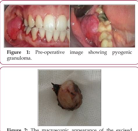 Pdf Pyogenic Granuloma In Pregnancy A Case Report Semantic Scholar