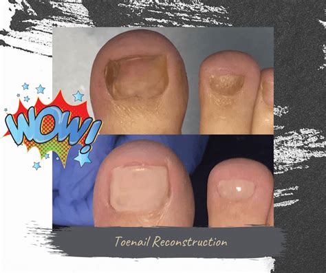 How To Fix Damaged Toenails At Josephine Szymanski Blog