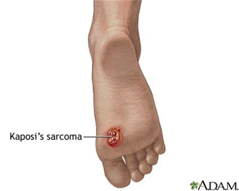 Kaposi's Sarcoma: Causes, Types, Symptoms, Diagnostics and Treatment