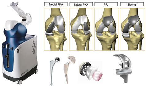 Robotic Hip And Knee Replacement Melbourne Shane Blackmore