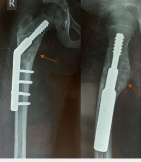 Postoperative Radiograph Anteroposterior And Lateral Views Download Scientific Diagram