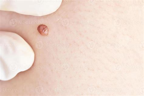 Woman examing her abnormal mole. Dermatology procedure. Doctor checking patient skin cancer ...