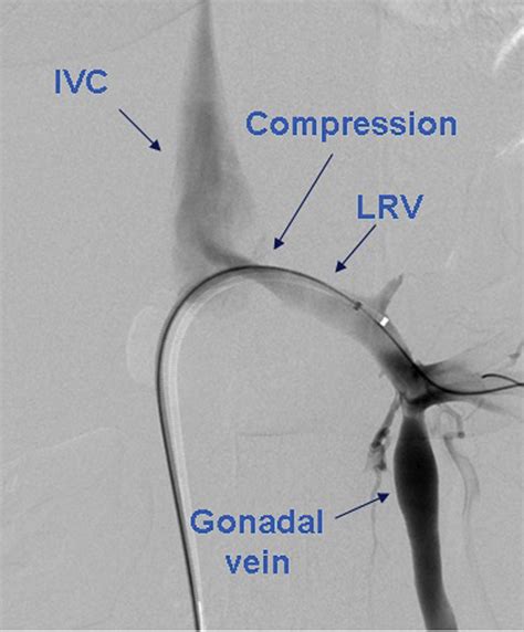 Gonadal Vein Transposition In Nutcracker Syndrome Annals Of Vascular