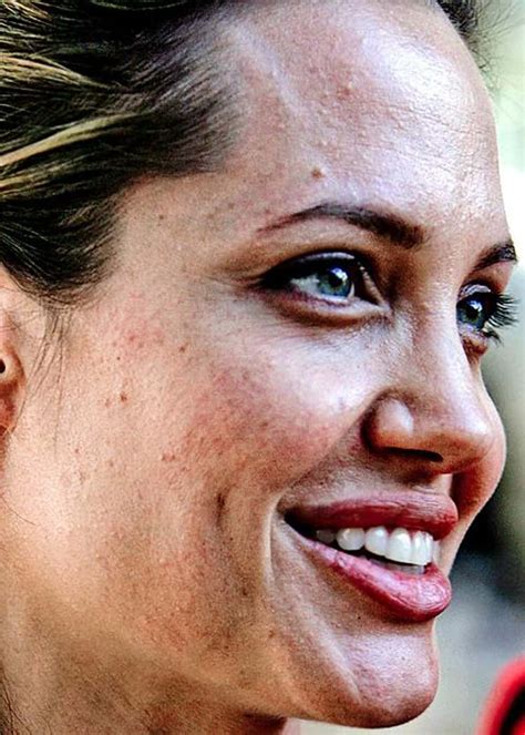 Celebrities With Bad Skin 2022