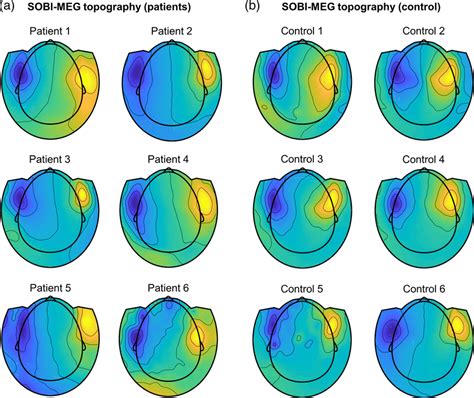 Second‐order Blind Identification Sobi Magneto Encephalographic Meg