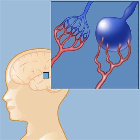 Vein of Galen Malformation | Neurological Surgery