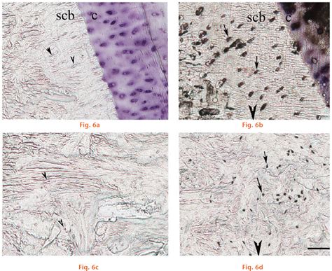 Increased Sclerostin Associated With Stress Fracture Of The Third