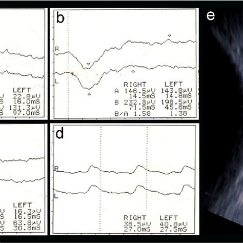 Ocular Findings In Alagille Syndrome A A Slit Lamp Photograph Of The