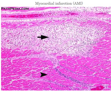 Angiotensin Ii Destabilizes Coronary Plaques In Watanabe Off