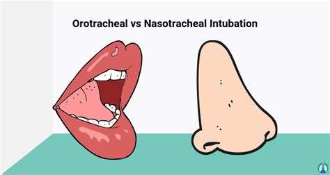 What is Intubation? (Procedure, Study Guide, and Practice Questions)