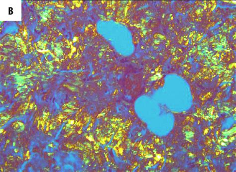 Characteristic Dichroism Of Amyloid On Polarized Light Examination A