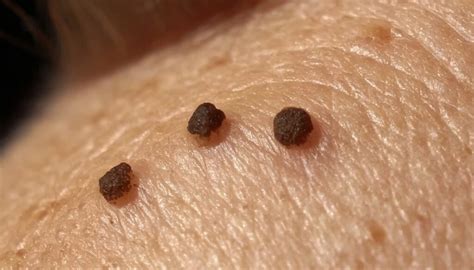 Get Rid Of The Barnacles On Your Skin A Guide To Seborrheic Keratosis