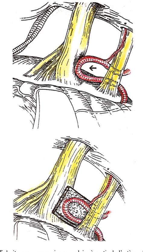 Figure From Neurochirurgie Fonctionnelle Dans Les Syndromes D