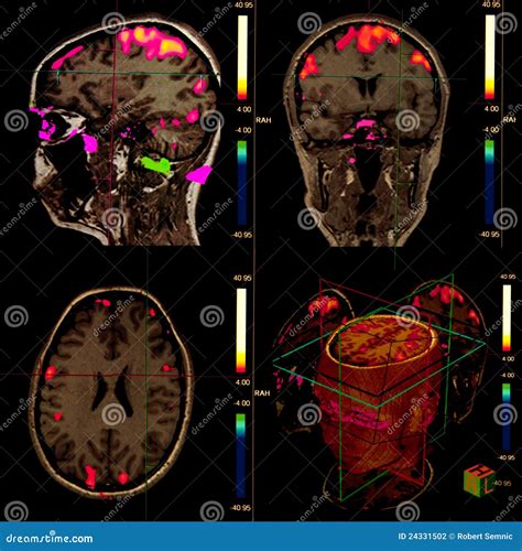 Functional Brain Magnetic Resonance Stock Photography Image