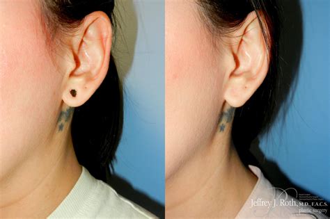 Earlobe Repair Surgery Before And After Pictures Case Las Vegas