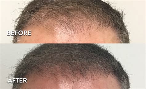 Prp Hair Loss Before And After Pictures Hair Restoration Results Photos