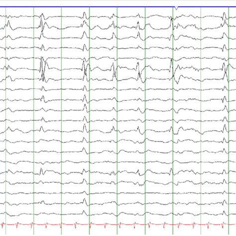 Lateralized Periodic Discharges Lpds At A Frequency Of Approximately