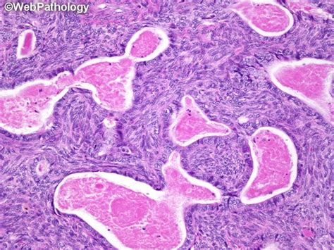 Synovial Sarcoma