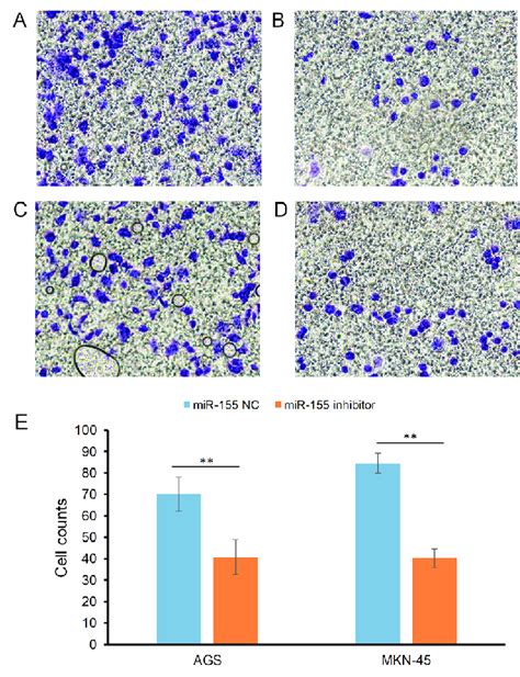 Effect Of Mir 155 On The Invasive Ability Of Gastric Carcinoma Cells