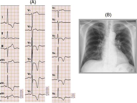 A Twelve Lead Electrocardiogram Showing High R Waves In The Left