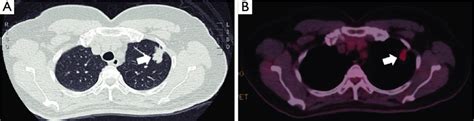 Preoperative Computed Tomography A And Positron Emission Tomography Download Scientific