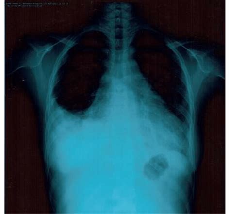 Anteroposterior Chest Radiography Showing Enlargement Of The Cardiac