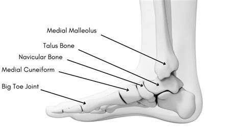 Medial Malleolus Fracture | Medial Malleolus Avulsion Fracture