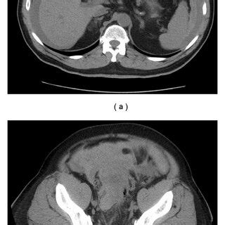 Preoperative Computed Tomography Scan Of The Abdomen Showing Extensive