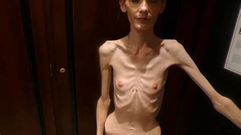 Anorexic Denisa T